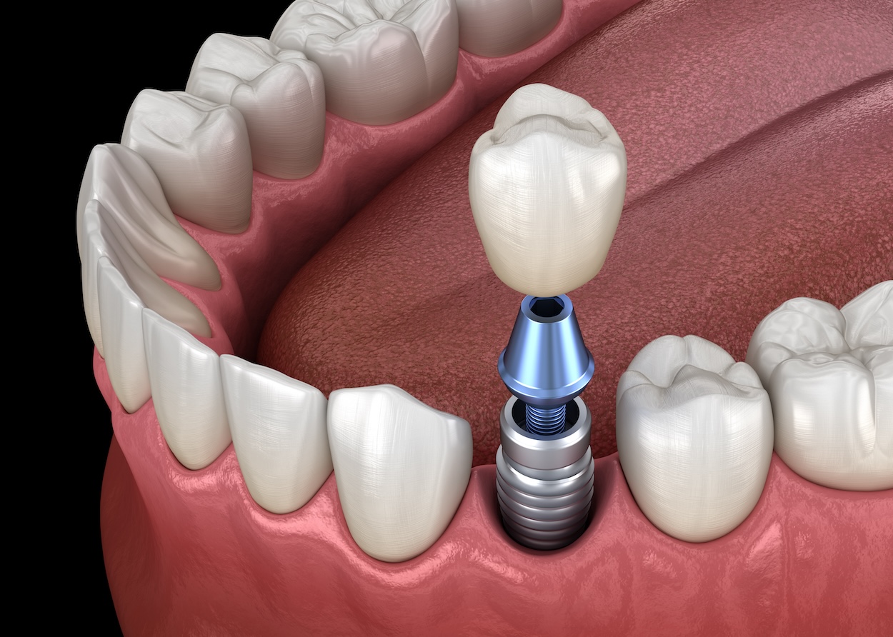 dental implant options, single tooth implants, implant-supported bridges, All-on-4 implants, mini implants, Bayshore Dental Center, Seffner FL, tooth replacement, dental care, oral health