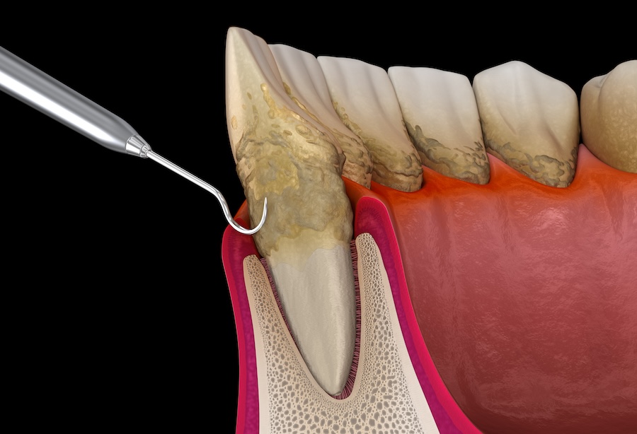 deep cleaning, gum disease, scaling and root planing, plaque, tartar, bleeding gums, receding gums, Bayshore Dental Center, Seffner FL